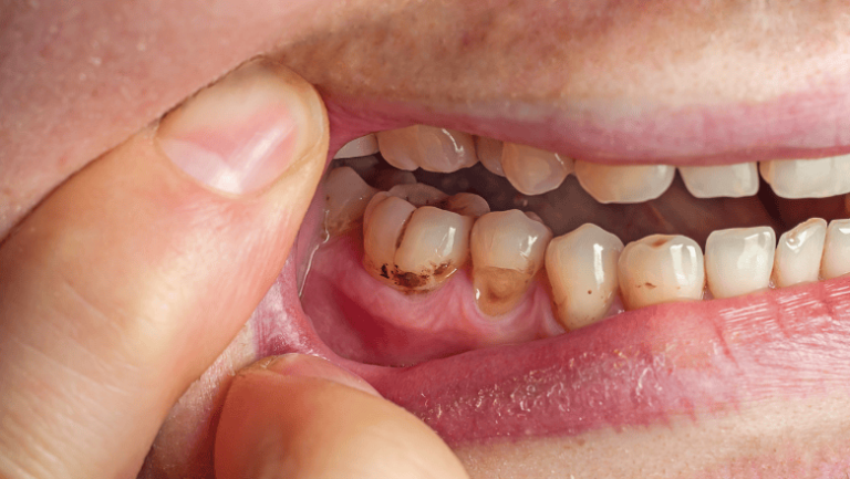 How to Protect Your Baby’s Teeth from Bottle Tooth Decay