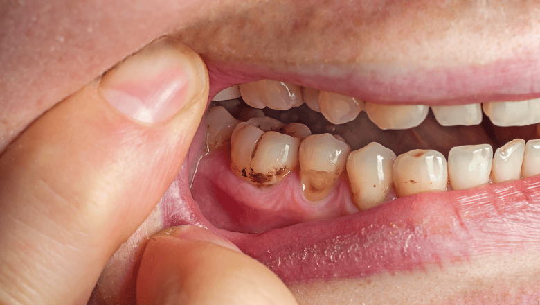 How to Protect Your Baby’s Teeth from Bottle Tooth Decay
