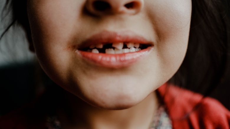 Enamel Hypoplasia in Children