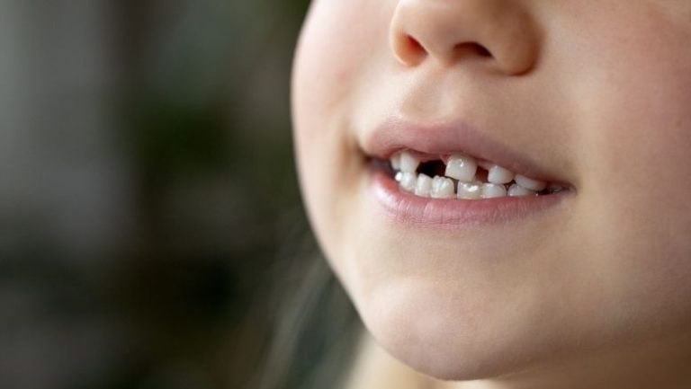 children teeth loss